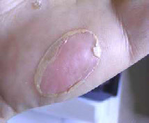 Fire / Heat burn blister caused through twirling after 12 days