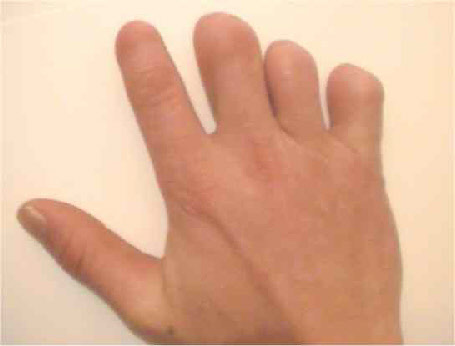 Thalidomide hand